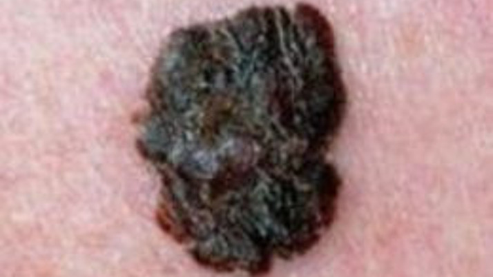 Cilt kanserini önce kuaförler görebilir